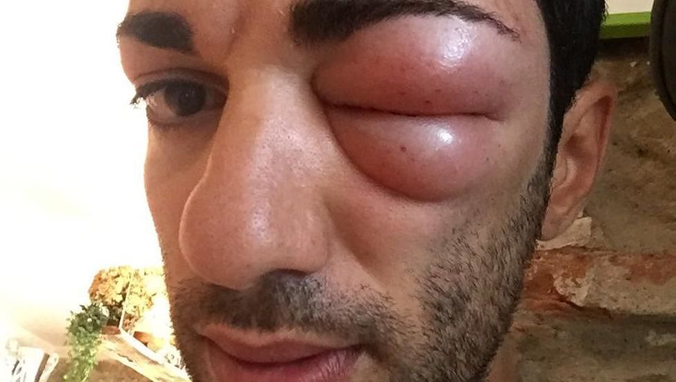 Celano shock, sfigurato dalla puntura di un insetto: l’occhio super gonfio del ciclista