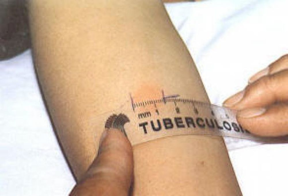 Maestra con la tubercolosi contagia otto alunni: in Italia 4mila nuovi casi all’anno