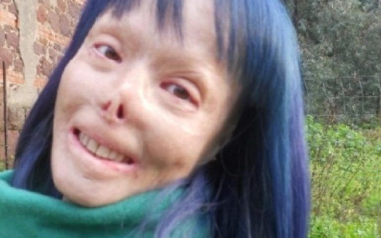 Sfigurata dal fuoco e poi indagata per omicidio: chiesta l’archiviazione per Valentina Pitzalis