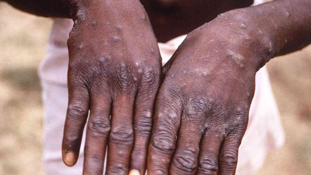 Vaiolo delle scimmie, c’è il secondo caso in Sardegna