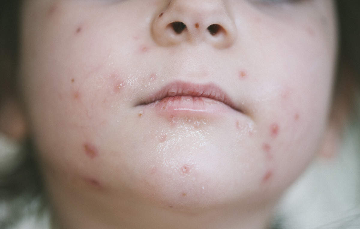 Cagliari, l’odissea di una mamma: “Mio figlio vaccinato dopo la varicella ma niente scuola senza certificato Asl”